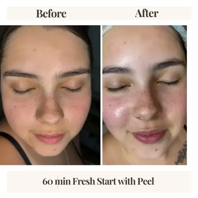 Before and after facial result Denver