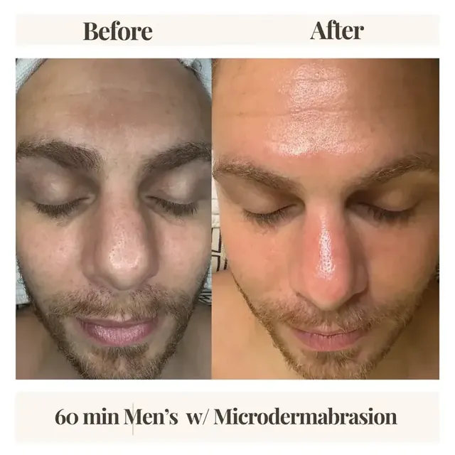 Before and after men's facial Denver
