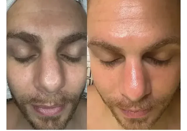 Before and after men's facial Denver