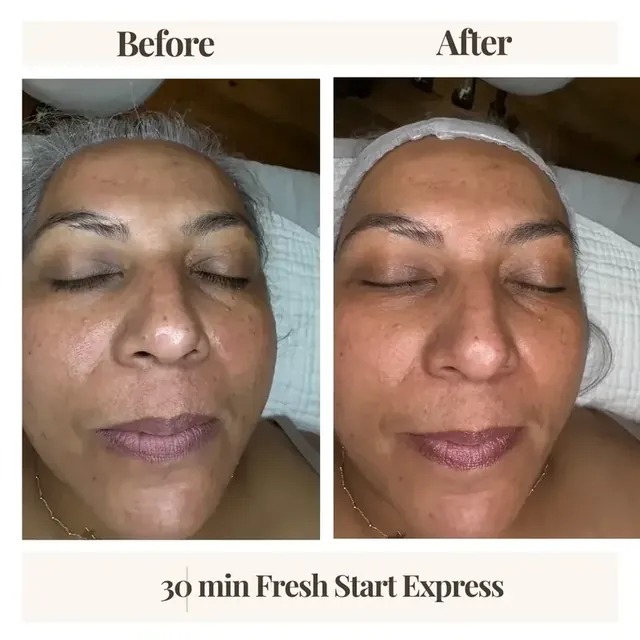 Before and after facial result Denver