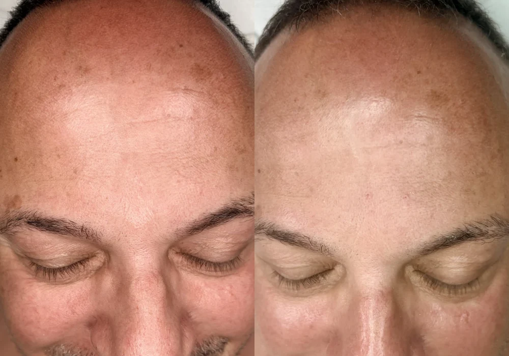 Before and after men's facial Denver