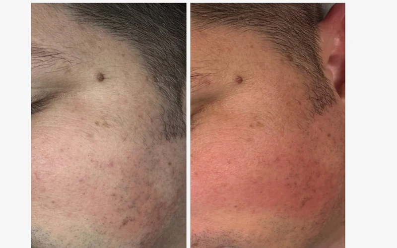 Before and after microdermabrasion Denver