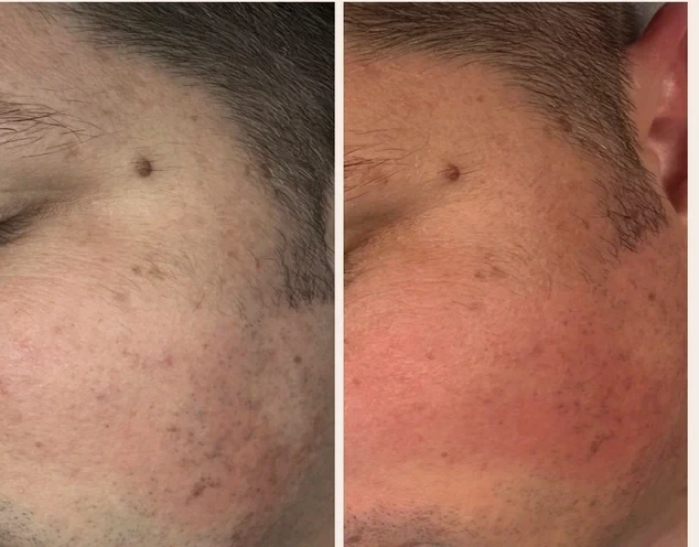 Before and after microdermabrasion Denver