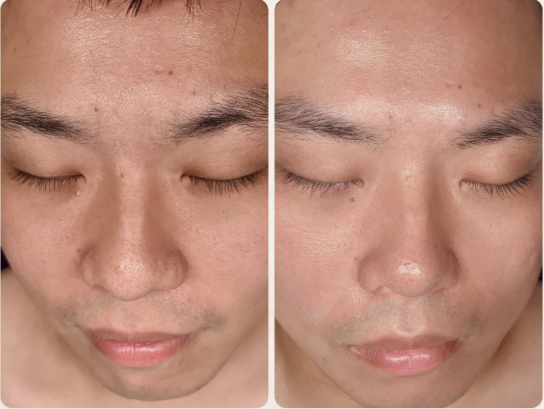 Before and after men's facial Denver