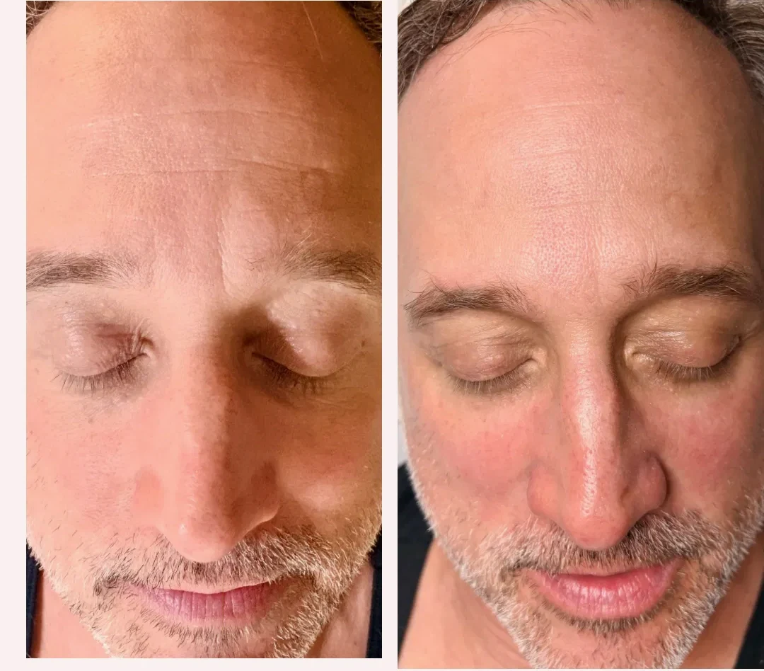 Before and after men's facial Denver