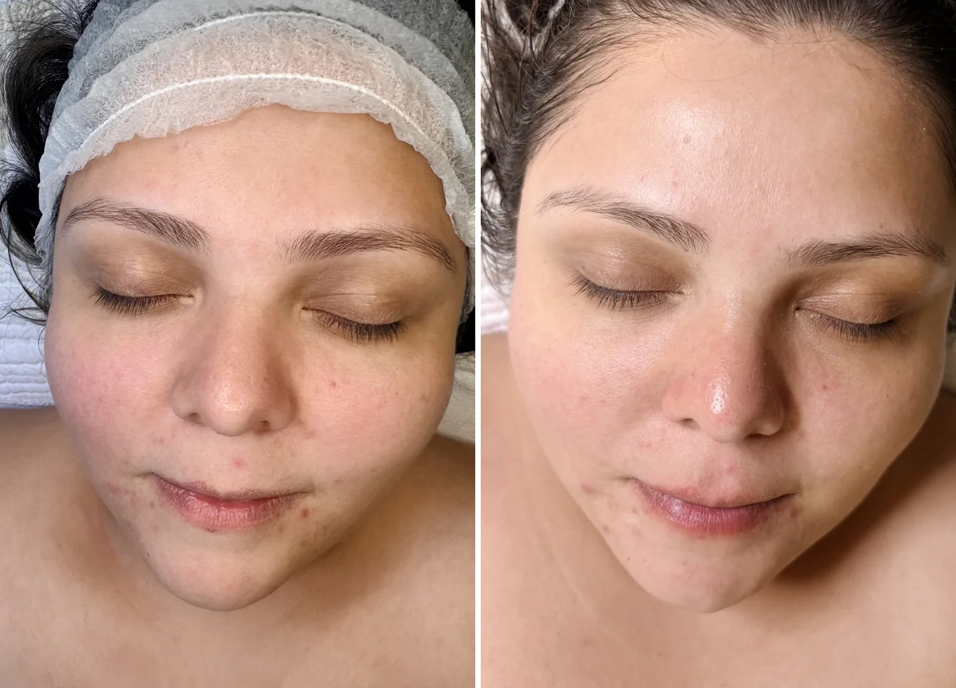 Before and after women's facial for breakouts and redness, Denver Skin Therapy