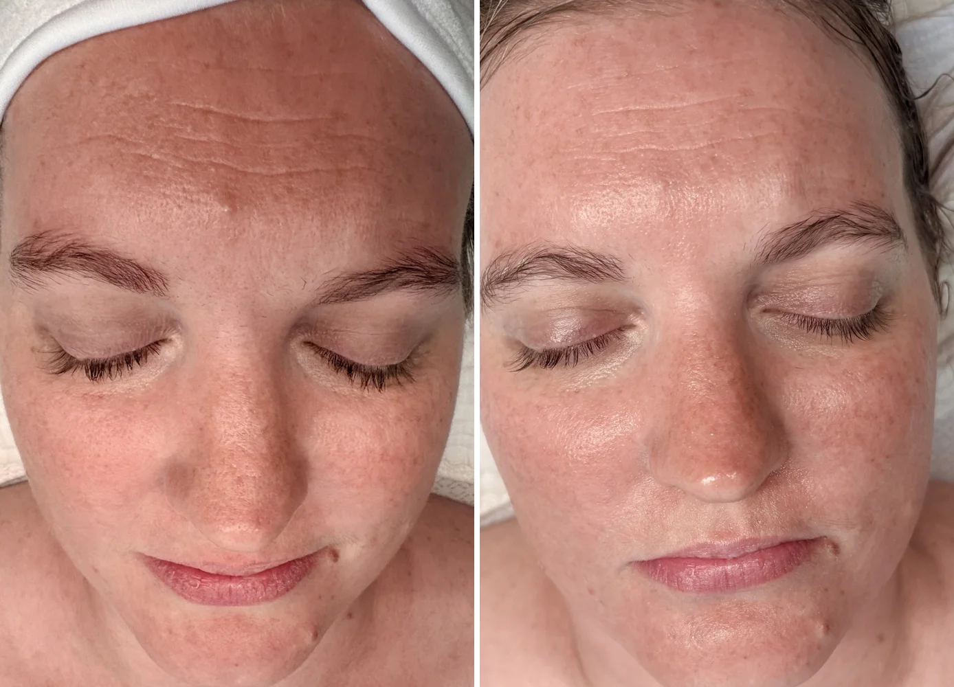 Before and after women's facial for texture and dullness, Denver Skin Therapy